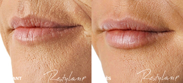 Bouche avec Restylane Lipp® - Dr Fays-Michel - Dermatologue NANCY