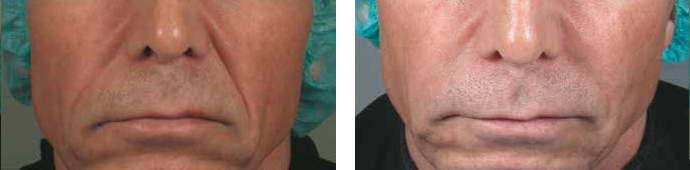 Ellansé® / Sillons nasogéniens : Avant traitement & Après 12 mois - Dr Fays-Michel - Dermatologue NANCY