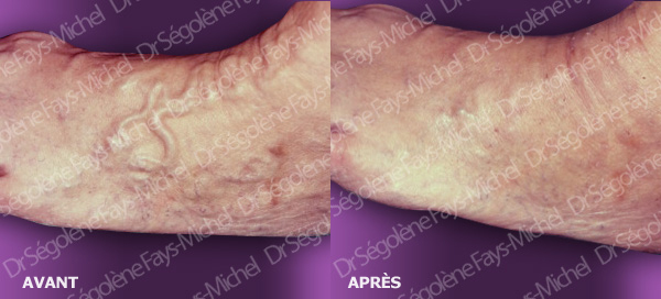 Phlebectomie ambulatoire - Dr Fays-Michel - Dermatologue NANCY