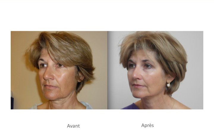 Résultats Silhouette soft® - Dr Fays-Michel - Dermatologue NANCY