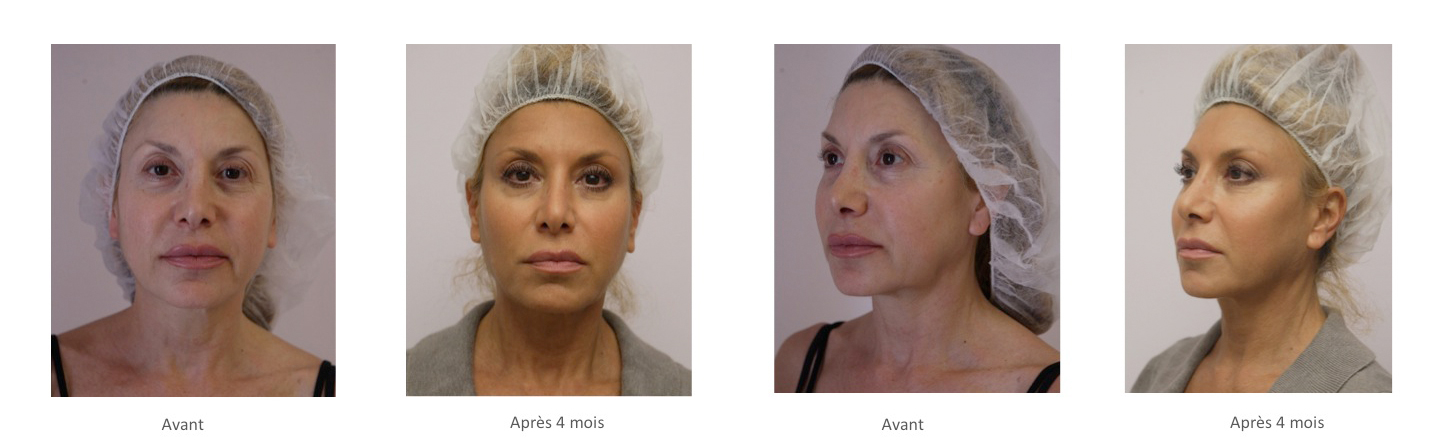 Résultats Silhouette soft® - Dr Fays-Michel - Dermatologue NANCY