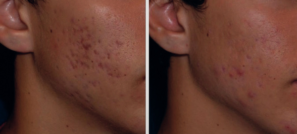 Cynosure® / traitement cicatrices d'acné - Dr Fays-Michel - Dermatologue NANCY