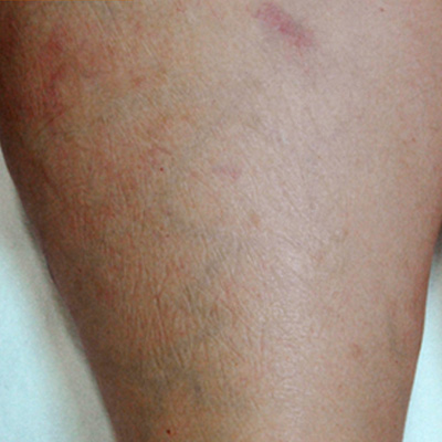 Traitement des varicosités par laser vasculaire - Dr Fays-Michel - Dermatologue NANCY
