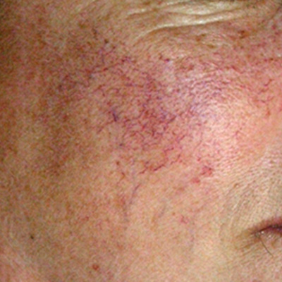 Traitement de la couperose par laser vasculaire - Dr Fays-Michel - Dermatologue NANCY