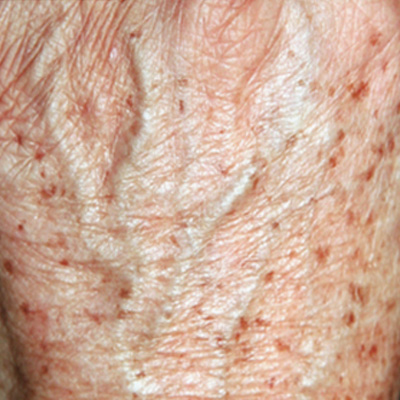 Traitement des mains par laser pigmentaire - Dr Fays-Michel - Dermatologue NANCY