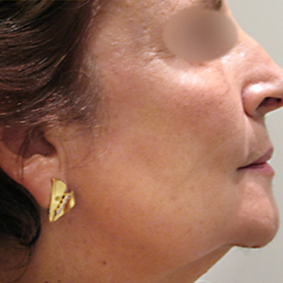 Traitement du visage par laser pigmentaire - Dr Fays-Michel - Dermatologue NANCY